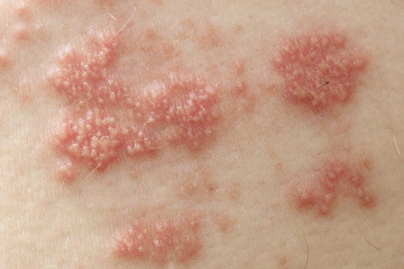Shingles rarely appear after Pfizer vaccination (study)