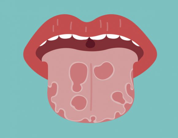 ‘혀’에 생기는 설암… 먹는 즐거움 어떡하나
