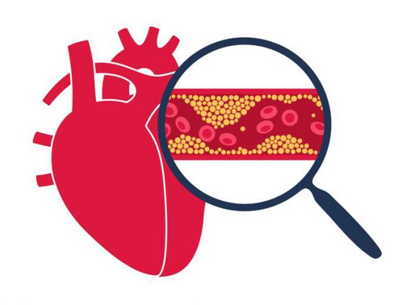 나쁜 콜레스테롤(LDL)이 심장에 얼마나 나쁠까?
