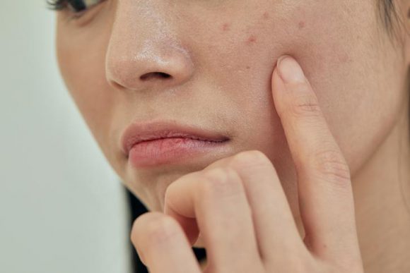 ﻿피부트러블, 비듬, 탈모… 지루피부염이 원인