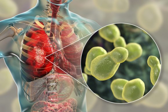 “폐 감염 일으키는 곰팡이, 약물 내성 획득” (연구)