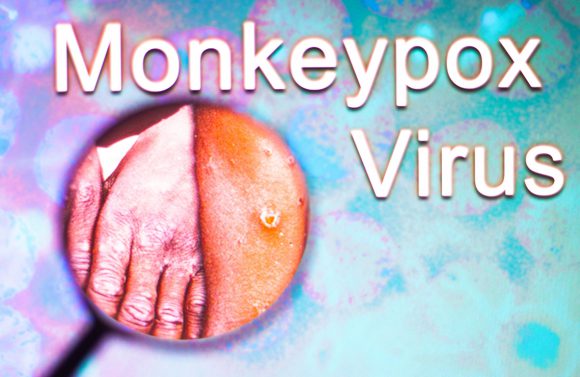 ‘원숭이 두창’바이러스 진단키트 개발 활발…출시 시점은 ‘몰라’
