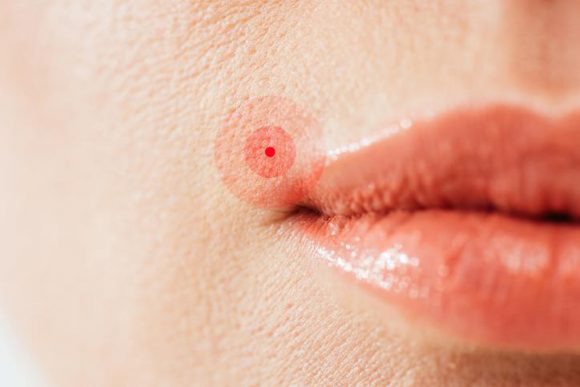 ﻿입술포진은 성병? 헤르페스에 대한 오해 5