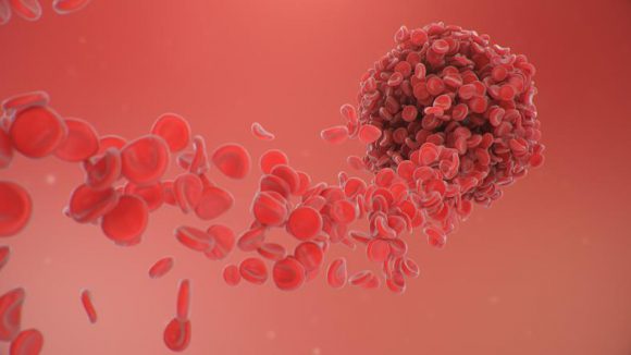 ﻿생명 위협하는 ‘혈전’ 생기는 이유 6가지