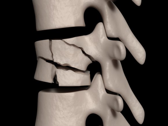 툭 하면 부러지는 뼈…노화 골절 막아주는 슈퍼 푸드