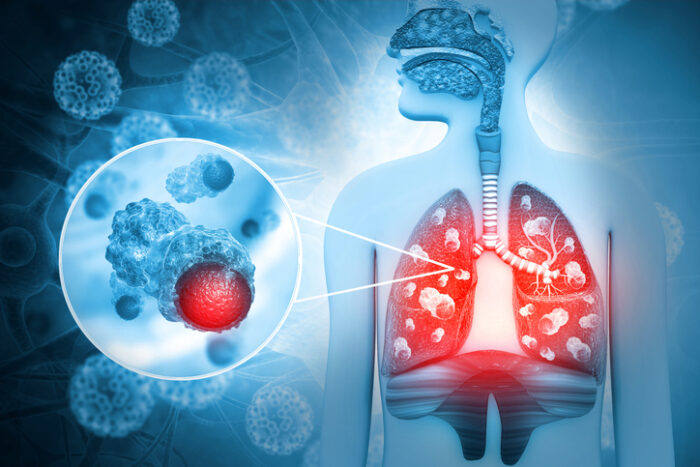 폐암 조기검진, 장기 생존율 ‘획기적으로’ 높여
