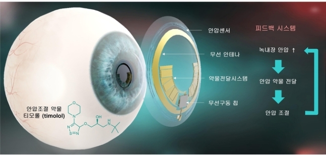 “안압 재고 약물 투여까지”…녹내장 관리하는 스마트 콘택트렌즈