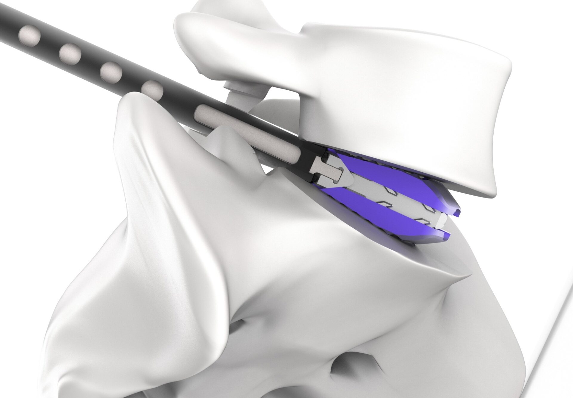 시지바이오, 척추유압술 삽입용 높이확장형 케이지 ‘엑센더’ 출시