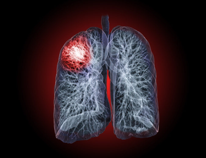 Emergence of AI predicts lung cancer... 