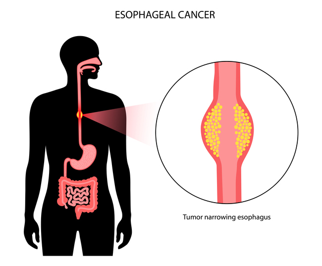 물조차 삼키기 어려운 고통 ‘식도암’…항암치료 변화는?