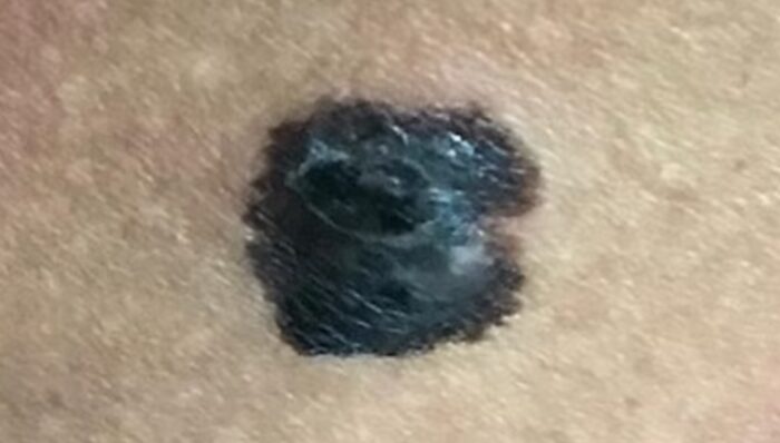 “Black Spot on Buttocks Leads to Melanoma: One Woman’s Skin Cancer Story”