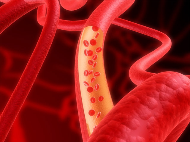 “내 핏속의 지방 덩어리”… 혈관 망치는 고지혈증 어떻게?