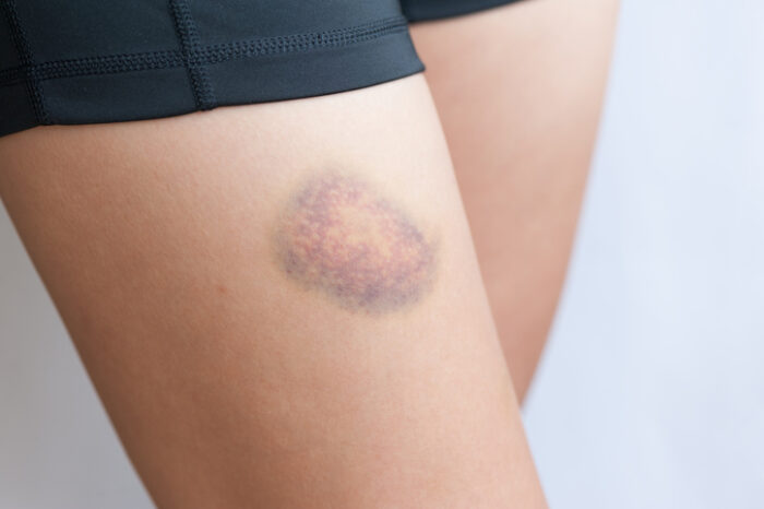 When Bruises Appear Without Any Bumps: Common Causes and Concerns