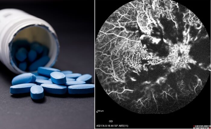 A Case of Vision Loss in an Iranian Man after Taking Sildenafil: A Report to the Academic World