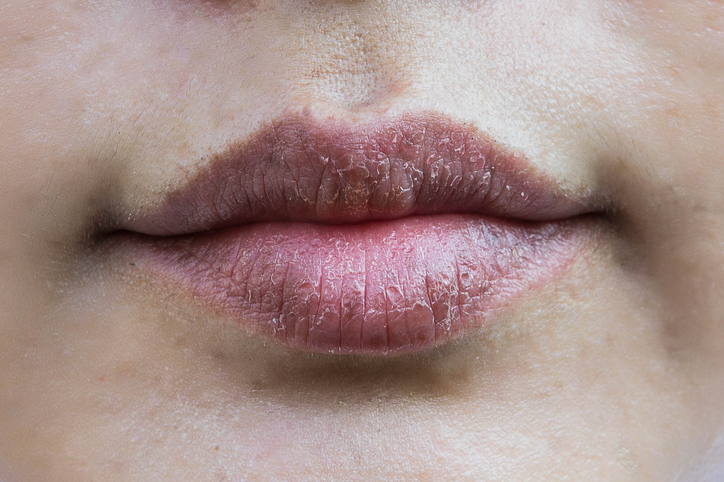 트고 갈라진 입술, 위장 건강 적신호?