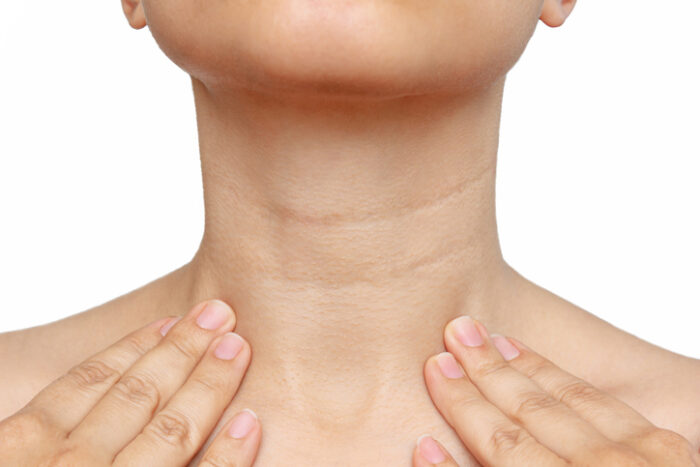 Preventing Neck Wrinkles: Tips for Posture and Skincare