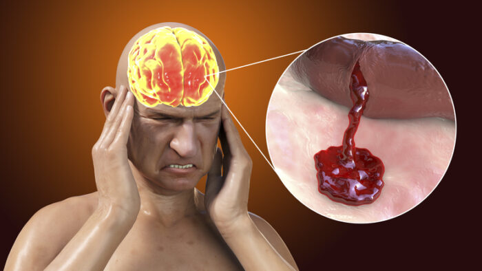 뇌졸중 앓는 사람…치매 위험 80% 까지 높아진다