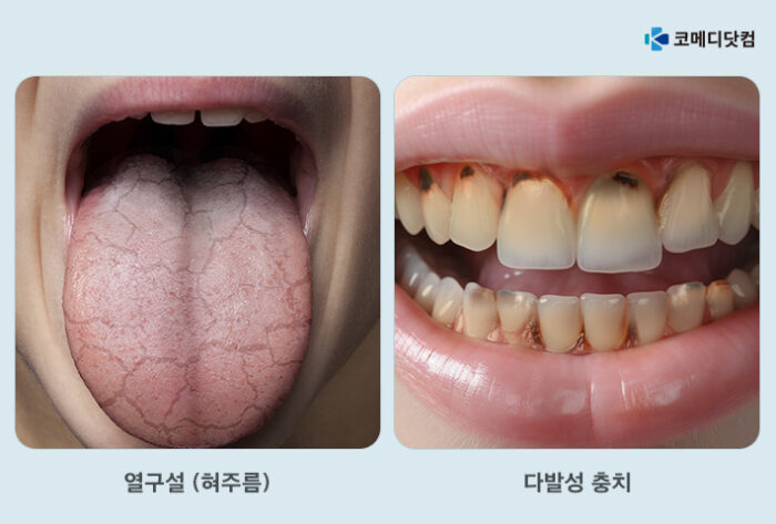 나이들면 왜 치과질환이 잘 생길까? 정답은 ‘입이 마르기 때문’