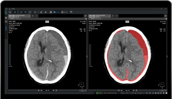 코어라인 “뇌출혈 진단 보조 AI, 비급여 청구 시작”