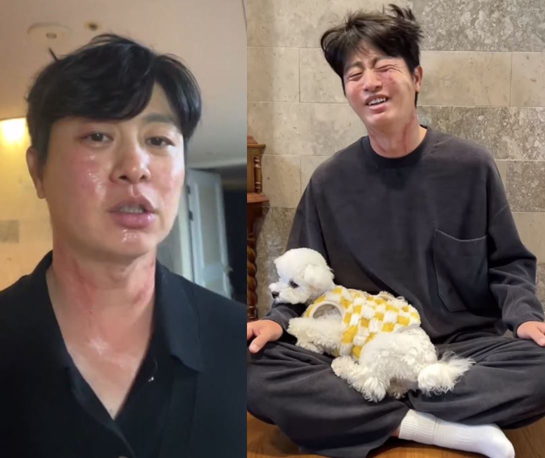 ユ・サンム、「顔の首に赤い傷は何？」…20日間ゴルフをしたときに「これ」のせい？
