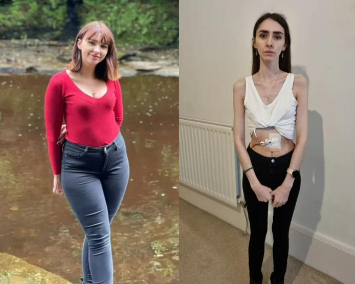 “I lost 40kg in 6 months”… A 30-year-old woman who became extremely thin, only 24kg?