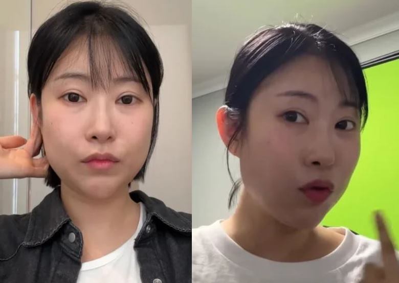 Seyoung Lee « Mon visage paraît plus court après avoir reçu cette procédure »… Vous pouvez facilement devenir jeune ?