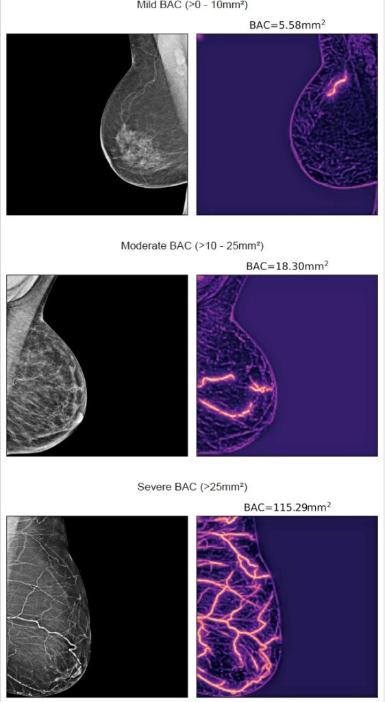Al pasar una mamografía por IA, también calcula «al instante» la probabilidad de enfermedad cardiovascular