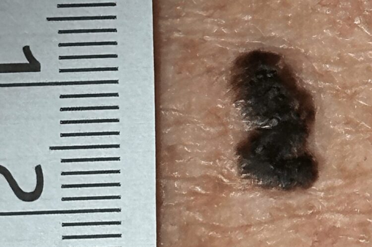«Pensaron que era cáncer, pero por suerte no lo era»… No era un lunar común: ¿qué era en realidad?