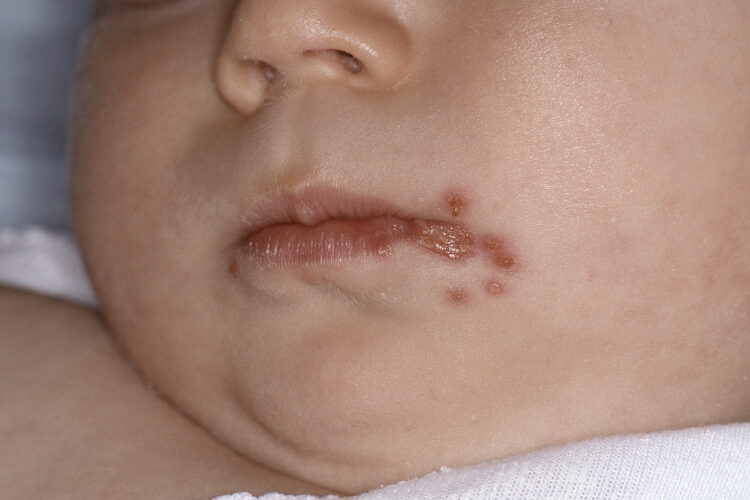 Manchas rojas en la cara de un niño: parecía sarpullido por el sudor, pero podría ser una infección cutánea contagiosa