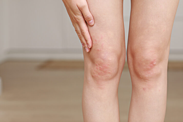 Las partículas finas amenazan no solo a los pulmones, también a la piel: el riesgo de psoriasis aumenta hasta un 27%