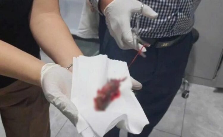 입에 잠깐 물었는데, 식도로 쏙… ‘이 물고기’ 때문에 응급실 行, 무슨 일?