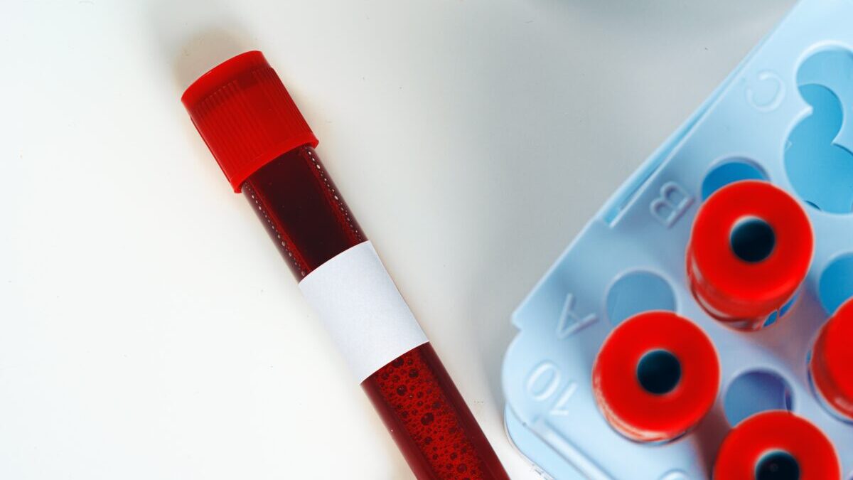 Unas vesículas en sangre explican por qué algunos pacientes no responden al rituximab