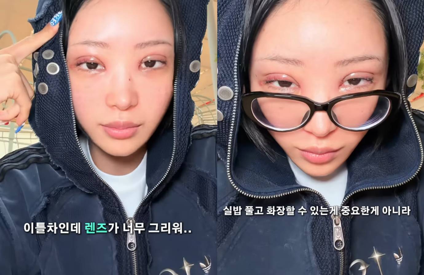 최준희, 또 성형수술 했다? 퉁퉁 부은 얼굴로 “더 못생겨 보여”