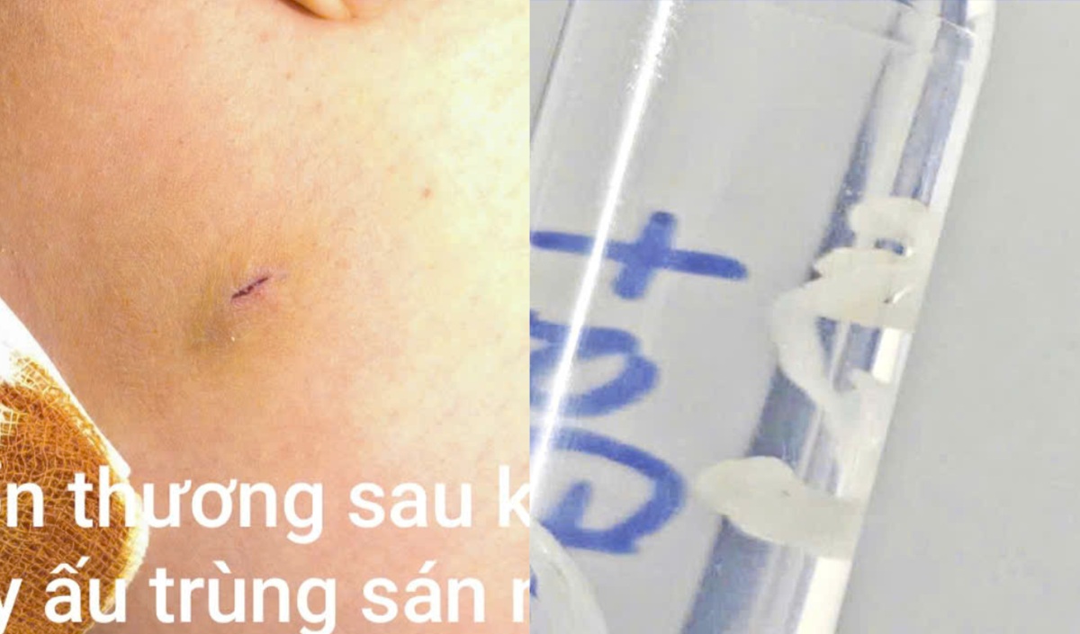 “계곡물 한 모금 삼켰을 뿐인데”… 피부밑에서 ‘7cm 기생충’ 살아 움직여