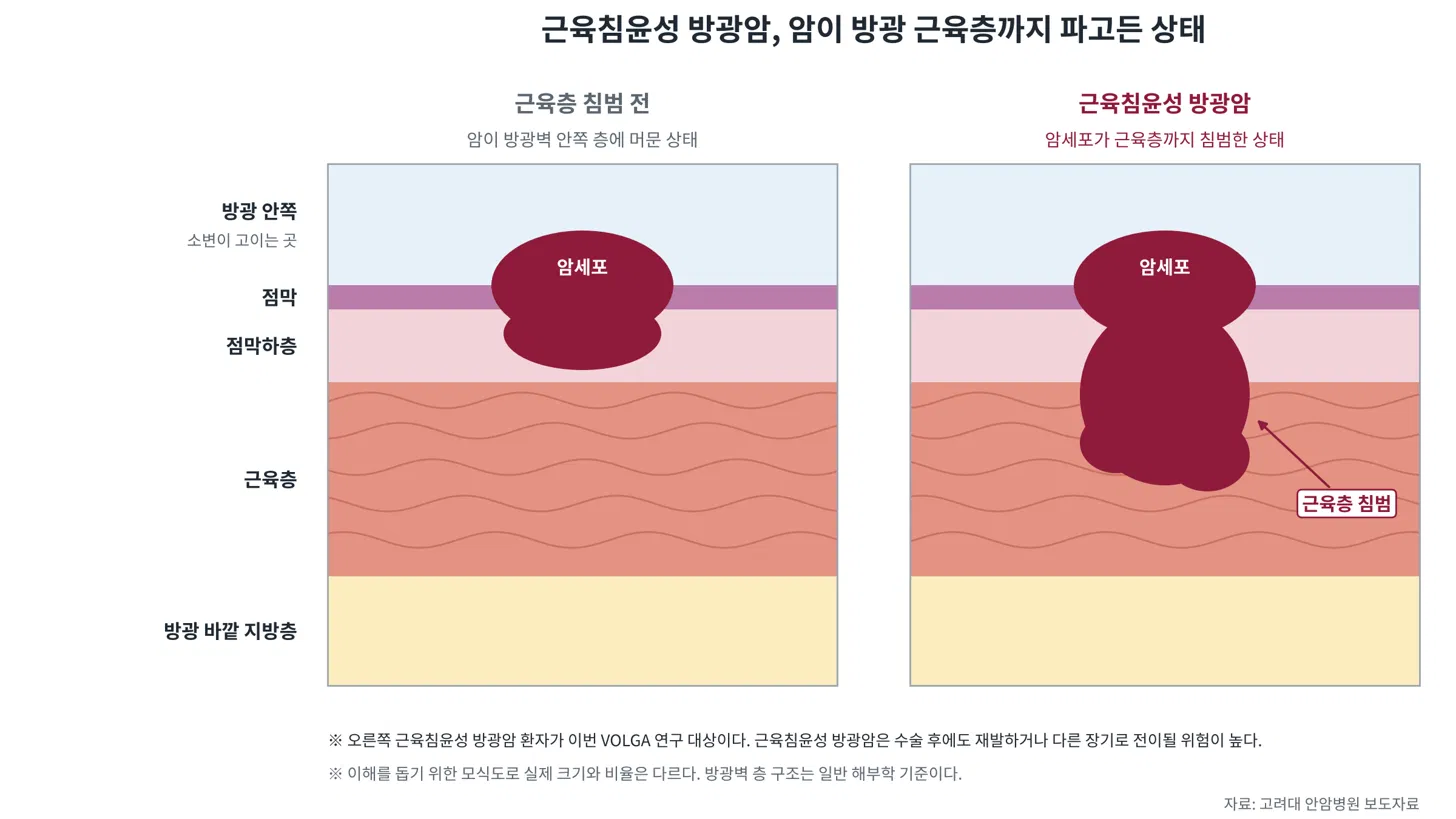 수술 전 항암제 2종 병용⋯대표 항암제 쓰기 어려운 방광암 환자 사망 위험 42% 낮아