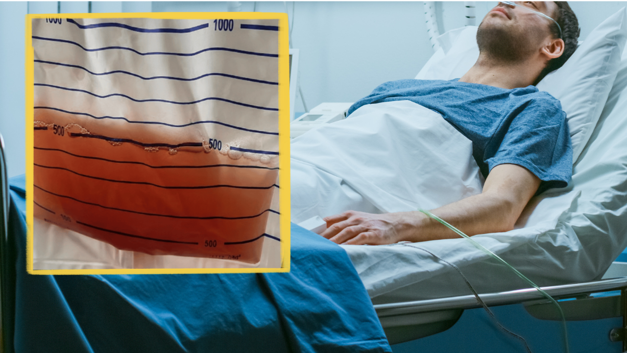 Two Patients With Amphetamine-Induced Rhabdomyolysis Treated, One Dies